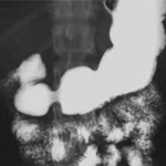 рентгеноскопия желудка