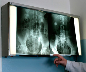 рентгеноскопия с барием