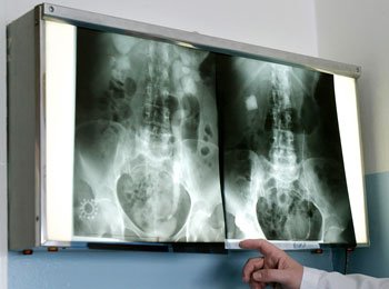 рентгеноскопия пищевода и желудка